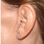 Facelift - Scar Before & After Patient #8167