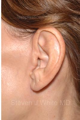 Facelift - Scar Before & After Patient #8167
