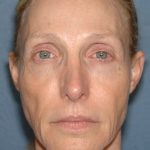 Upper & Lower Facelift - Brow Lift & Face/Neck Lift Before & After Patient #8027