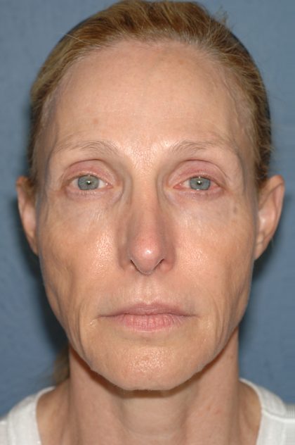 Upper & Lower Facelift - Brow Lift & Face/Neck Lift Before & After Patient #8027