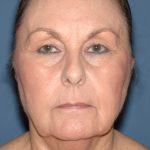 Upper & Lower Facelift - Brow Lift & Face/Neck Lift Before & After Patient #8301
