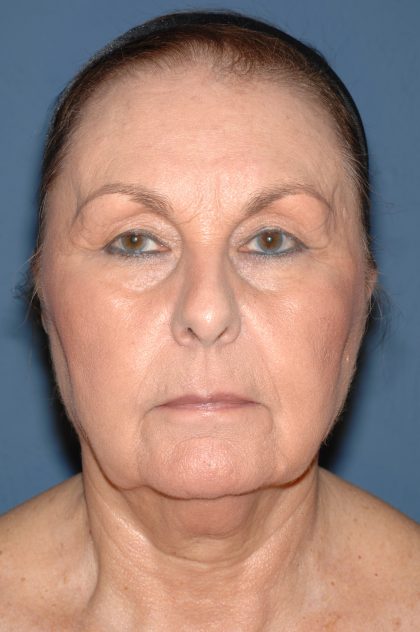 Upper & Lower Facelift - Brow Lift & Face/Neck Lift Before & After Patient #8301