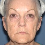 Upper & Lower Facelift - Brow Lift & Face/Neck Lift Before & After Patient #8302