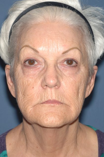 Upper & Lower Facelift - Brow Lift & Face/Neck Lift Before & After Patient #8302