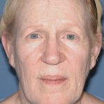 Upper & Lower Facelift - Brow Lift & Face/Neck Lift Before & After Patient #8303