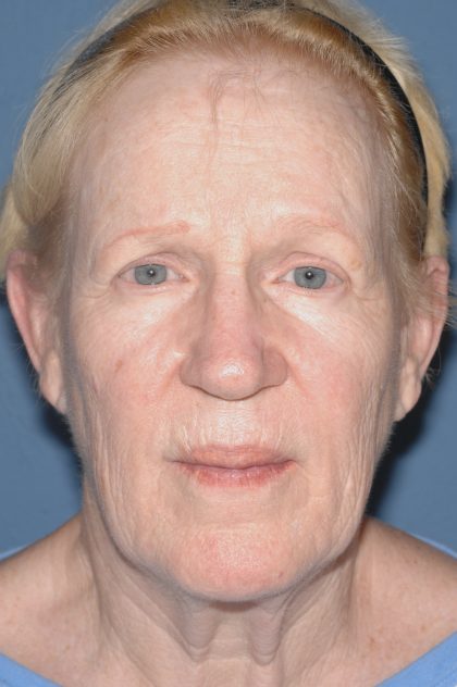 Upper & Lower Facelift - Brow Lift & Face/Neck Lift Before & After Patient #8303