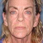 Upper & Lower Facelift - Brow Lift & Face/Neck Lift Before & After Patient #8304