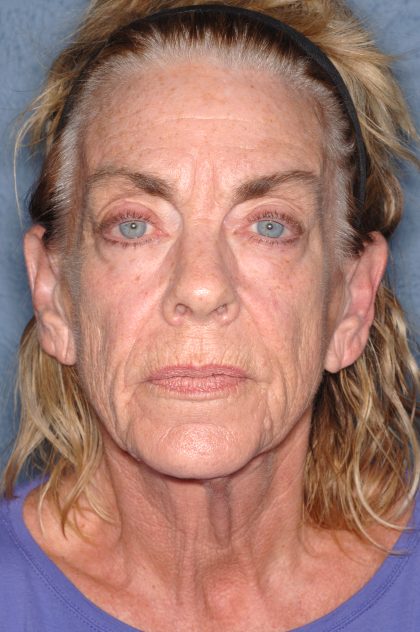 Upper & Lower Facelift - Brow Lift & Face/Neck Lift Before & After Patient #8304