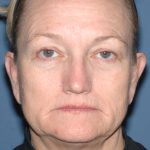 Upper & Lower Facelift - Brow Lift & Face/Neck Lift Before & After Patient #8305