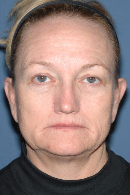 Upper & Lower Facelift - Brow Lift & Face/Neck Lift Before & After Patient #8305