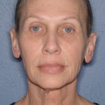 Upper & Lower Facelift - Brow Lift & Face/Neck Lift Before & After Patient #8026