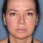 Upper & Lower Facelift - Brow Lift & Face/Neck Lift Before & After Patient #8028