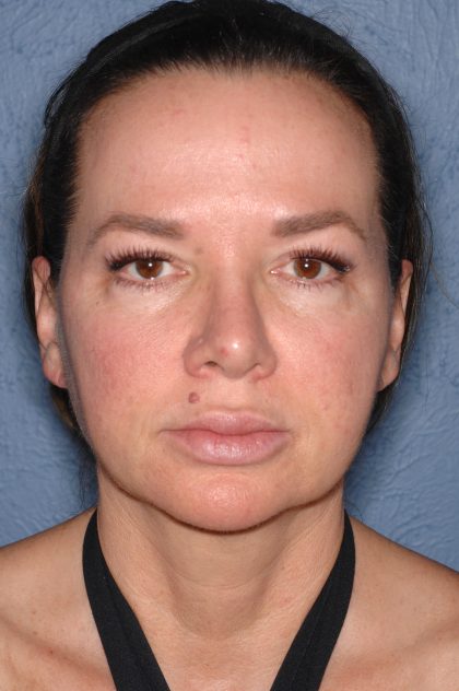 Upper & Lower Facelift - Brow Lift & Face/Neck Lift Before & After Patient #8028