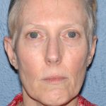 Upper & Lower Facelift - Brow Lift & Face/Neck Lift Before & After Patient #8029