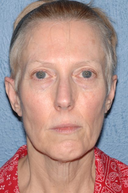 Upper & Lower Facelift - Brow Lift & Face/Neck Lift Before & After Patient #8029
