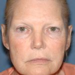 Upper & Lower Facelift - Brow Lift & Face/Neck Lift Before & After Patient #8030