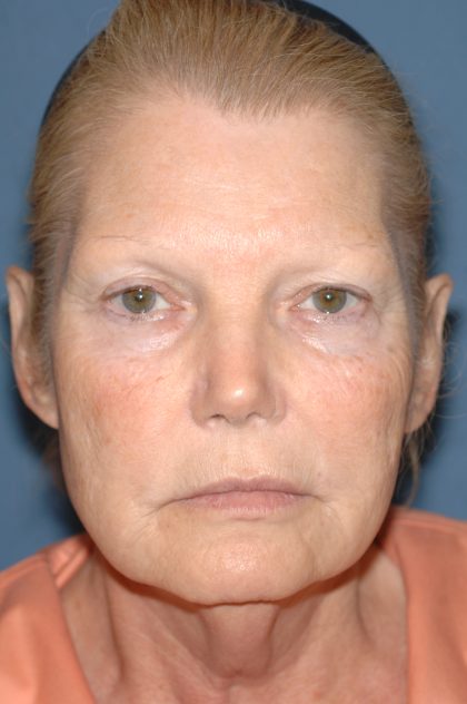 Upper & Lower Facelift - Brow Lift & Face/Neck Lift Before & After Patient #8030