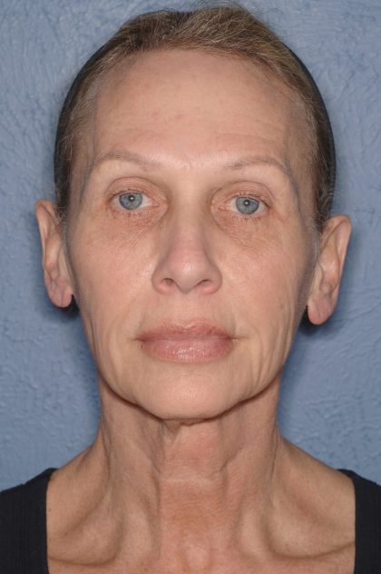 Upper & Lower Facelift - Brow Lift & Face/Neck Lift Before & After Patient #8026