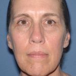 Upper & Lower Facelift - Brow Lift & Face/Neck Lift Before & After Patient #8031