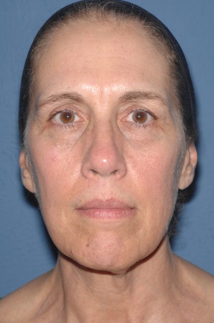 Upper & Lower Facelift - Brow Lift & Face/Neck Lift Before & After Patient #8031