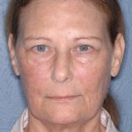 Upper & Lower Facelift - Brow Lift & Face/Neck Lift Before & After Patient #8032