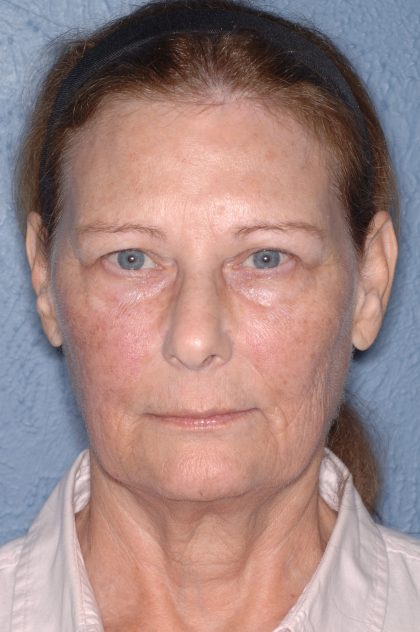 Upper & Lower Facelift - Brow Lift & Face/Neck Lift Before & After Patient #8032
