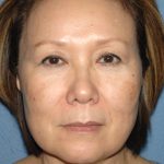Upper & Lower Facelift - Brow Lift & Face/Neck Lift Before & After Patient #8033