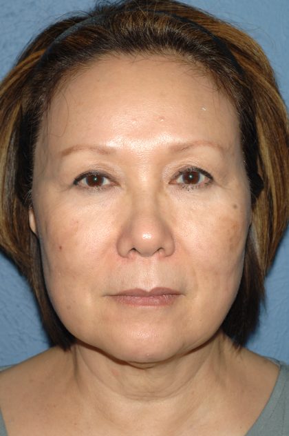 Upper & Lower Facelift - Brow Lift & Face/Neck Lift Before & After Patient #8033