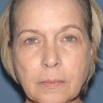 Upper & Lower Facelift - Brow Lift & Face/Neck Lift Before & After Patient #8034