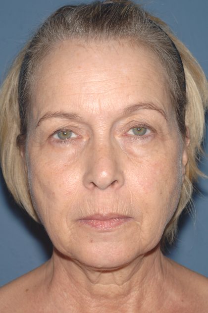 Upper & Lower Facelift - Brow Lift & Face/Neck Lift Before & After Patient #8034