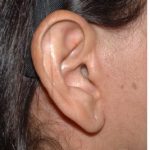 Facelift - Scar Before & After Patient #8176
