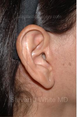 Facelift - Scar Before & After Patient #8176
