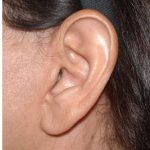Facelift - Scar Before & After Patient #8176
