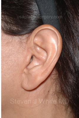 Facelift - Scar Before & After Patient #8176