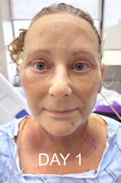 Facelift - Face/Neck (Lower) Before & After Patient #8032
