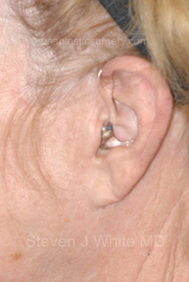 Upper & Lower Facelift - Brow Lift & Face/Neck Lift Before & After Patient #8303