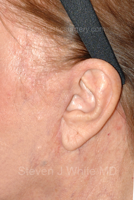 Upper & Lower Facelift - Brow Lift & Face/Neck Lift Before & After Patient #8301
