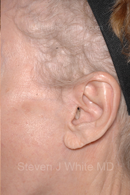 Upper & Lower Facelift - Brow Lift & Face/Neck Lift Before & After Patient #8029