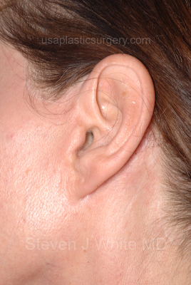 Upper & Lower Facelift - Brow Lift & Face/Neck Lift Before & After Patient #8028