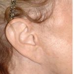 Facelift - Scar Before & After Patient #8219