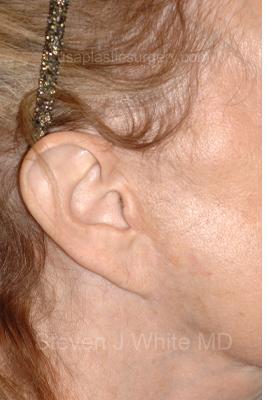 Facelift - Scar Before & After Patient #8219