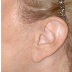 Facelift - Scar Before & After Patient #8219
