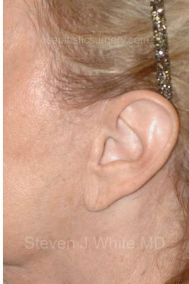 Facelift - Scar Before & After Patient #8219