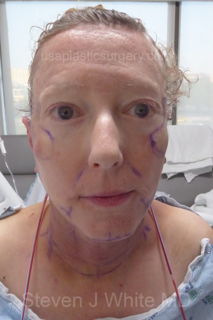 Upper & Lower Facelift - Brow Lift & Face/Neck Lift Before & After Patient #8029