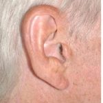 Facelift - Scar Before & After Patient #8220