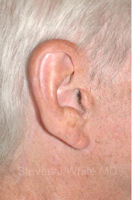 Facelift - Scar Before & After Patient #8220