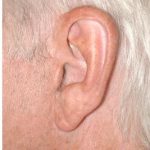 Facelift - Scar Before & After Patient #8220