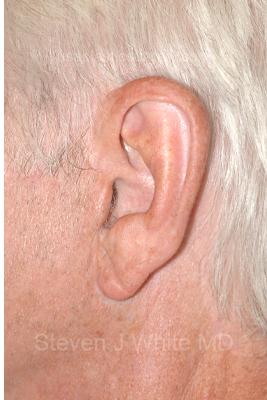 Facelift - Scar Before & After Patient #8220