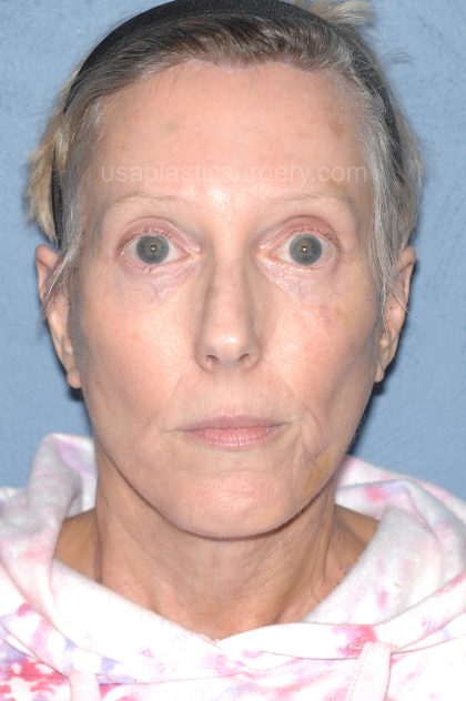 Upper & Lower Facelift - Brow Lift & Face/Neck Lift Before & After Patient #8029