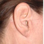 Facelift - Scar Before & After Patient #8221